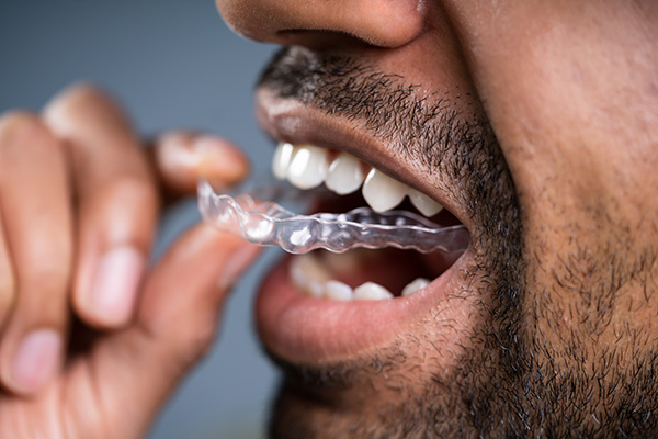 A Cosmetic Dentist Explains Benefits Of Clear Aligners
