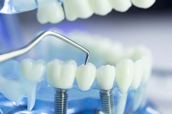 Do Dental Implants Look And Feel Natural?