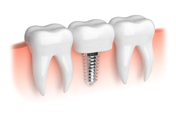 Understanding The Procedure For Dental Implants