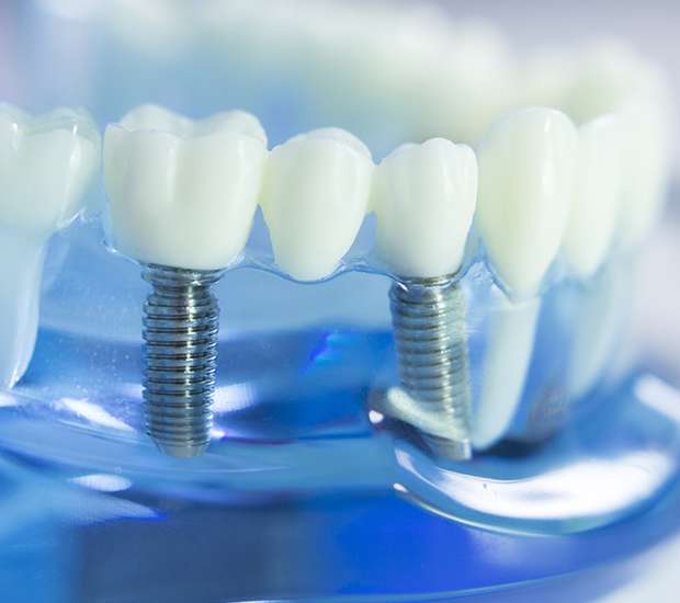 Farmington Dental Implants