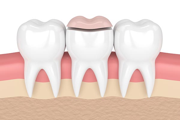 How A Cosmetic Dentist Can Place Inlays And Onlays