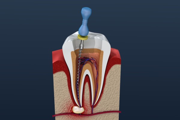 Root Canal Therapy From A General Dentist For A Cracked Tooth