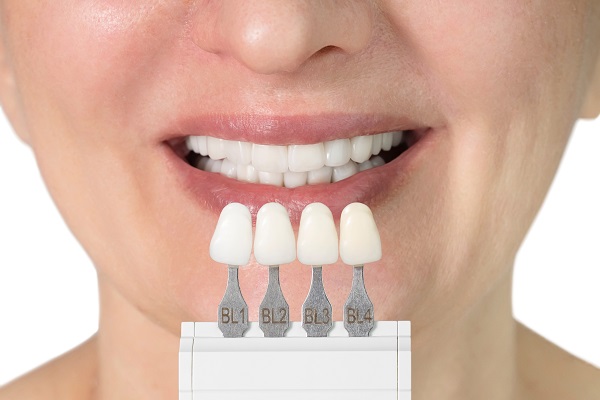 Ways To Prepare For Dental Veneers